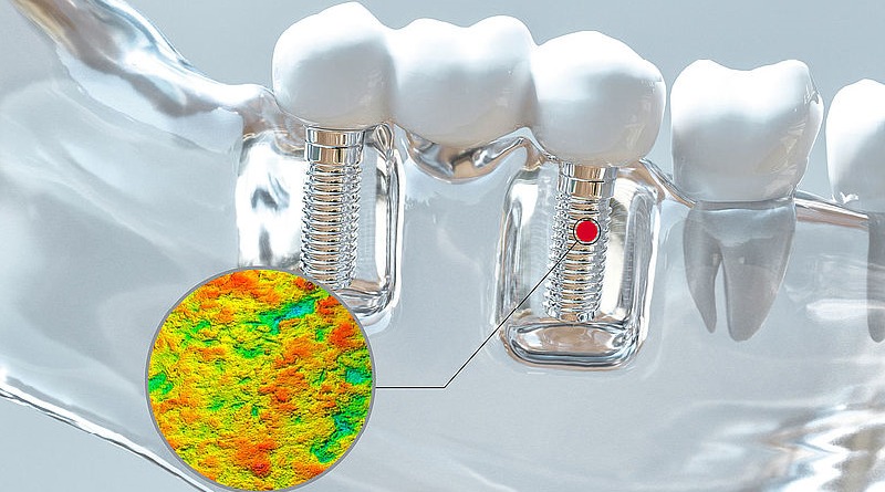 Painless Confocal Microscope Measurement of Dental Implants